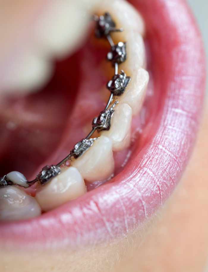 Unsichtbare Zahnspange Lingualtechnik